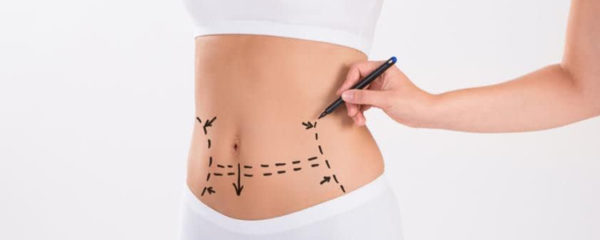 abdominoplastie