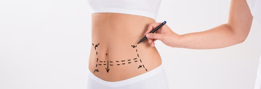 abdominoplastie